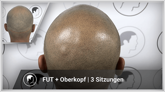 FUT + Oberkopf - 3 Sitzungen