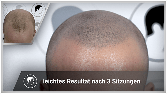 leichtes Resultat nach 3 Sitzungen