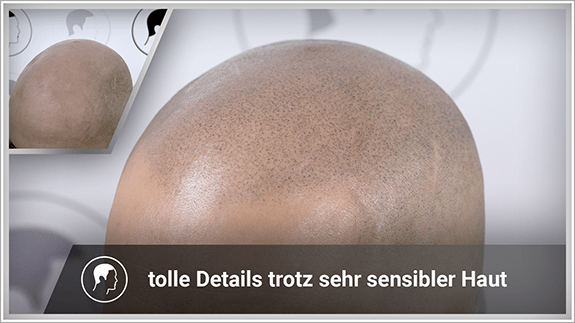 tolle Details trotz sehr senibler Haut