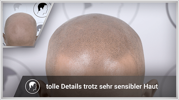 tolle Details trotz sehr senibler Haut