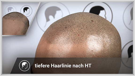 tiefere Haarlinie nach Haartransplantation