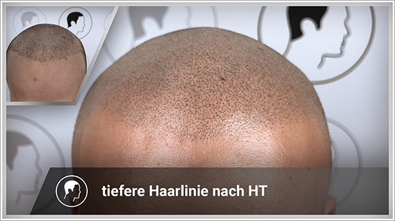 tiefere Haarlinie nach Haartransplantation