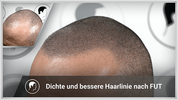 Dichte und bessere Haarlinie nach FUT