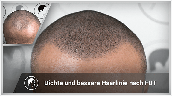 Dichte und bessere Haarlinie nach FUT