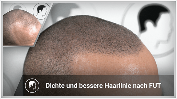Dichte und bessere Haarlinie nach FUT