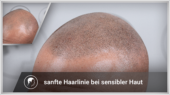 sanfte Haarlinie bei sensibler Haut