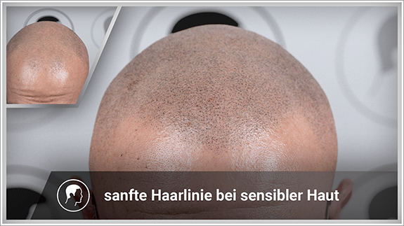 sanfte Haarlinie bei sensibler Haut