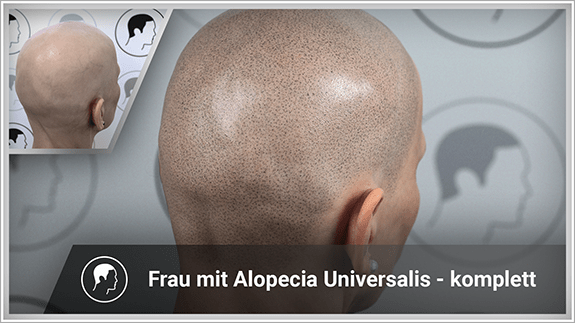 Frau mit Alopeica Universalis - komplette Haarpigmentierung