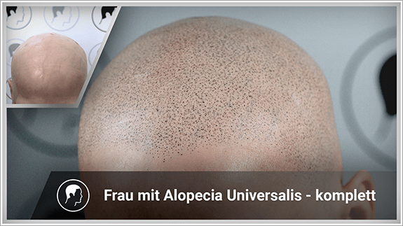 Frau mit Alopeica Universalis - komplette Haarpigmentierung