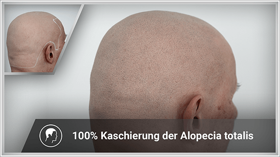 100% Kaschierung der Alopeica totalis