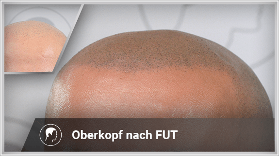 Oberkopf nach FUT