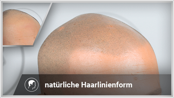 natürliche Haarlinienform