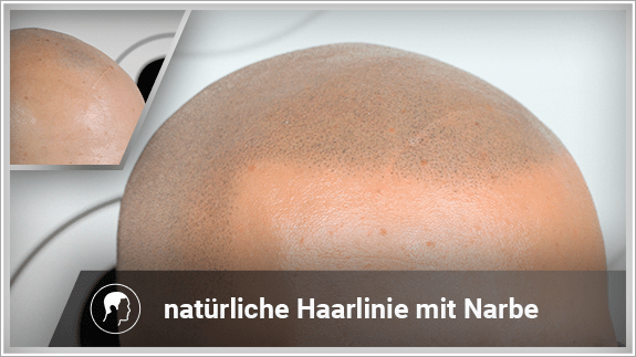 natürliche Haarlinie mit Narbe