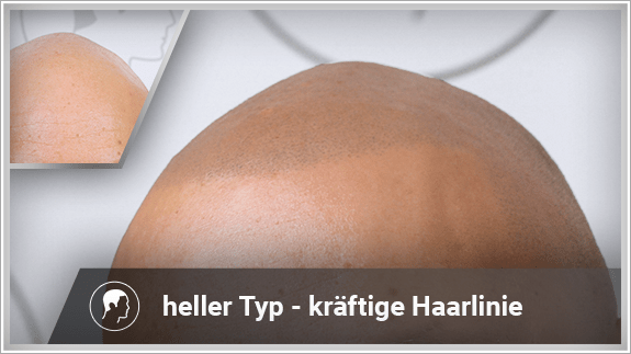 heller Typ - kräftige Haarlinie
