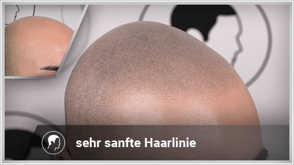 sehr sanfte Haarlinie