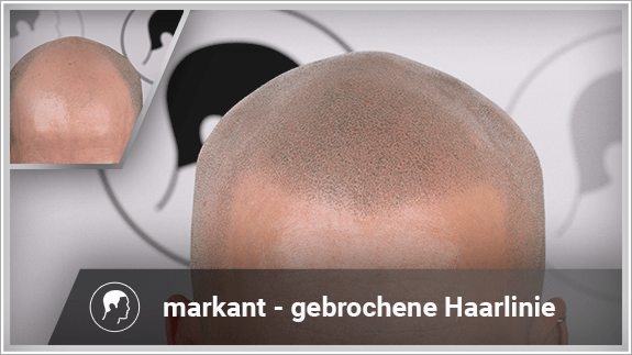 markant - gebrochene Haarlinie