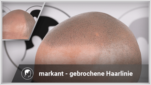 markant - gebrochene Haarlinie