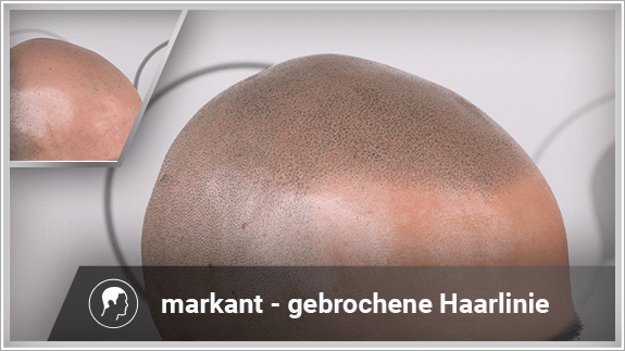 markant - gebrochene Haarlinie