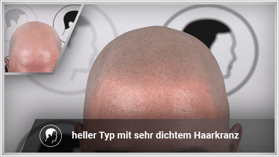 heller Typ mit sehr dichtem Haarkranz