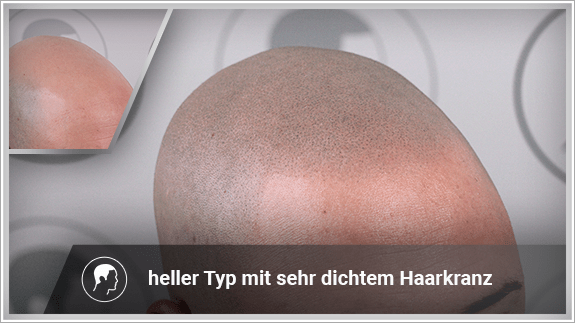 heller Typ mit sehr dichtem Haarkranz