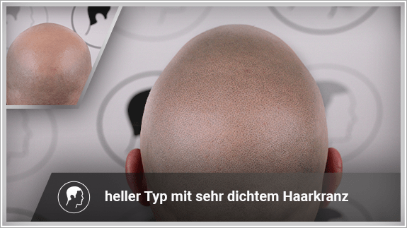 heller Typ mit sehr dichtem Haarkranz