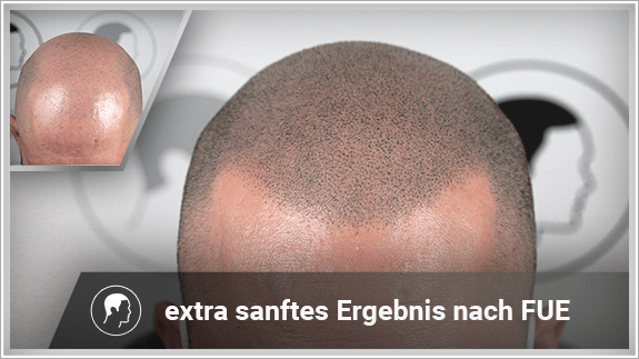 extra sanften Ergebnis nach FUE