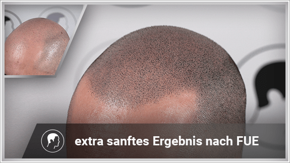 extra sanften Ergebnis nach FUE