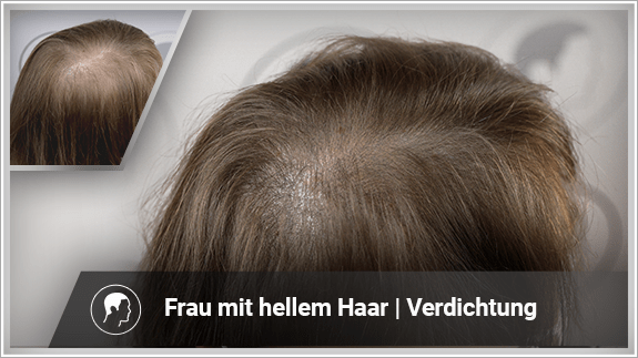 Haarverdichtung - Frau mit hellem Haar