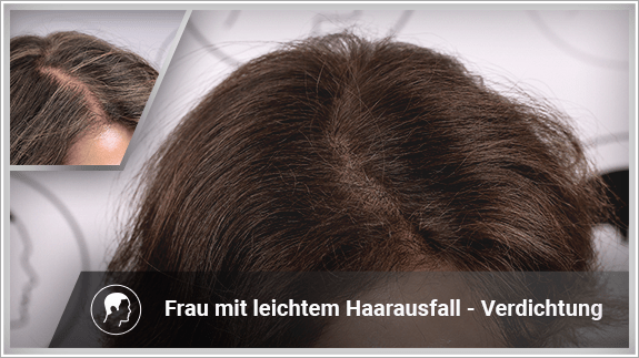 Frau mit leichtem Haarausfall - Verdichtung