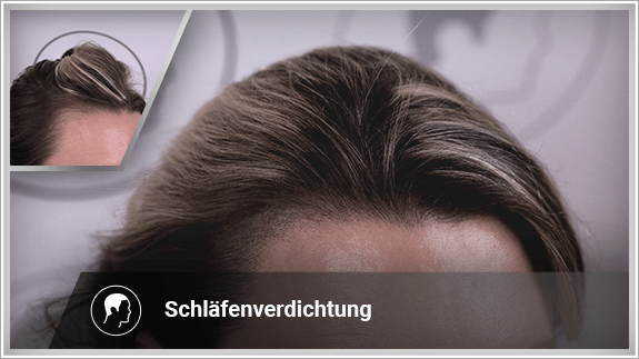 Schläfenverdichtung