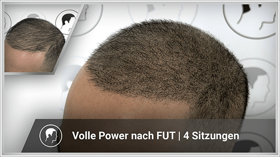 Volle Power nach FUT - 4 Sitzungen