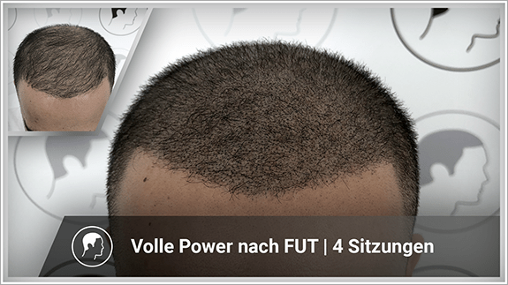 Volle Power nach FUT - 4 Sitzungen