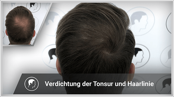 Verdichtung der Tonsur und Haarlinie