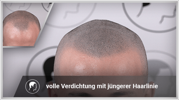 volle Verdichtung mit jüngerer Haarlinie