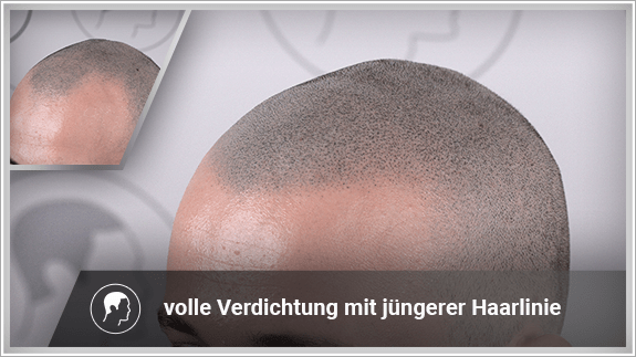 volle Verdichtung mit jüngerer Haarlinie