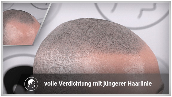 volle Verdichtung mit jüngerer Haarlinie