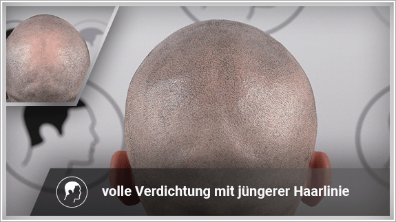 volle Verdichtung mit jüngerer Haarlinie