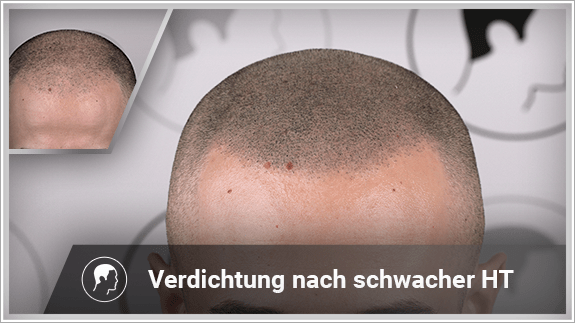 Verdichtung nach schwacher Haartransplantation