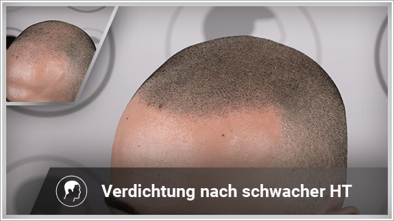 Verdichtung nach schwacher Haartransplantation