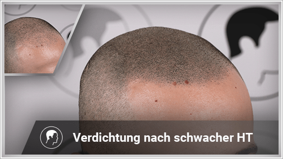 Verdichtung nach schwacher Haartransplantation