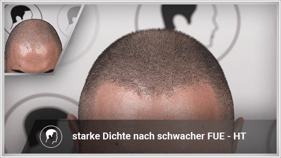 starke Dichte nach schwacher FUE - HT