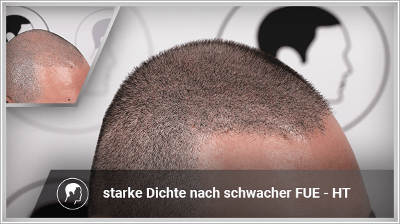 starke Dichte nach schwacher FUE - HT