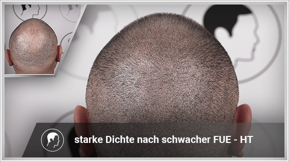 starke Dichte nach schwacher FUE - HT