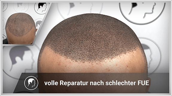 volle Reperatur nach schlechter FUE