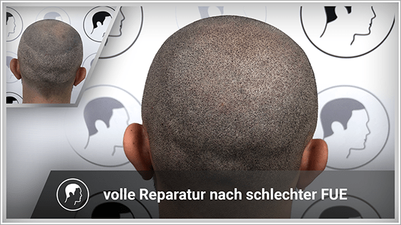 volle Reperatur nach schlechter FUE