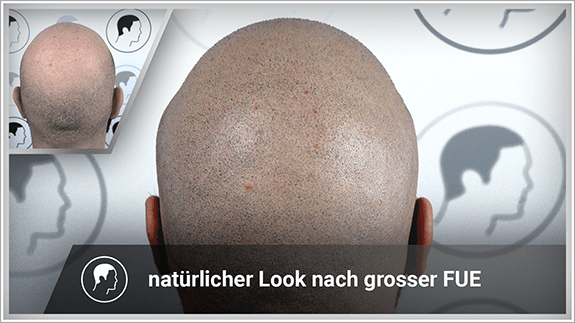 natürlicher Looker nach großer FUE