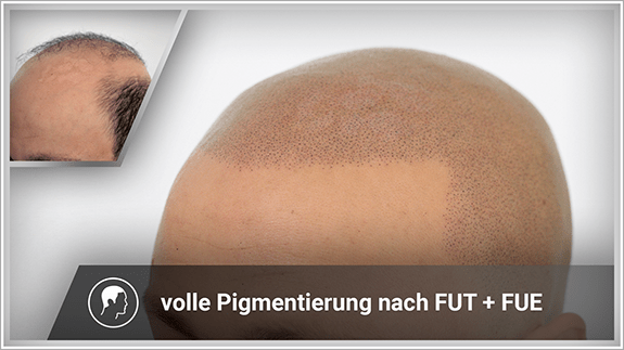volle Pigmentierung nach FUT und FUE