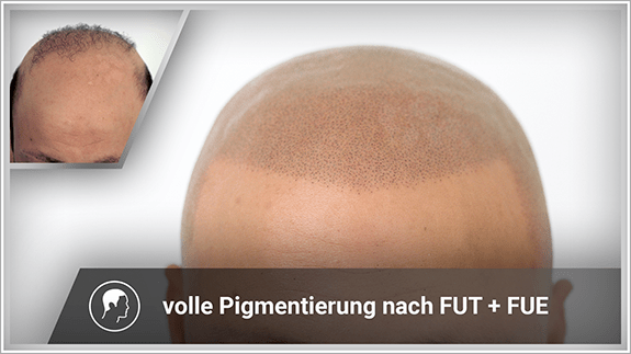 volle Pigmentierung nach FUT und FUE