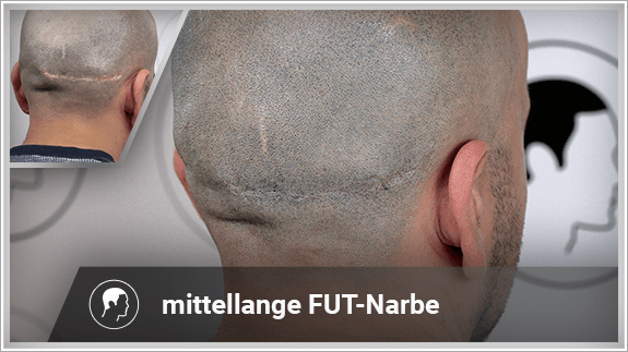 Kaschierung einer mittellangen FUT Narbe