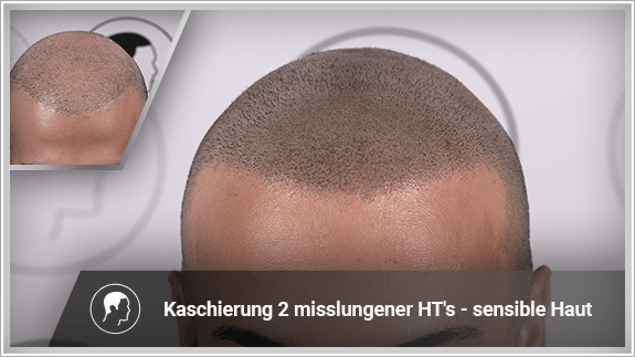 Kaschierung 2 misslungener Haartransplantationen - sensible Haut